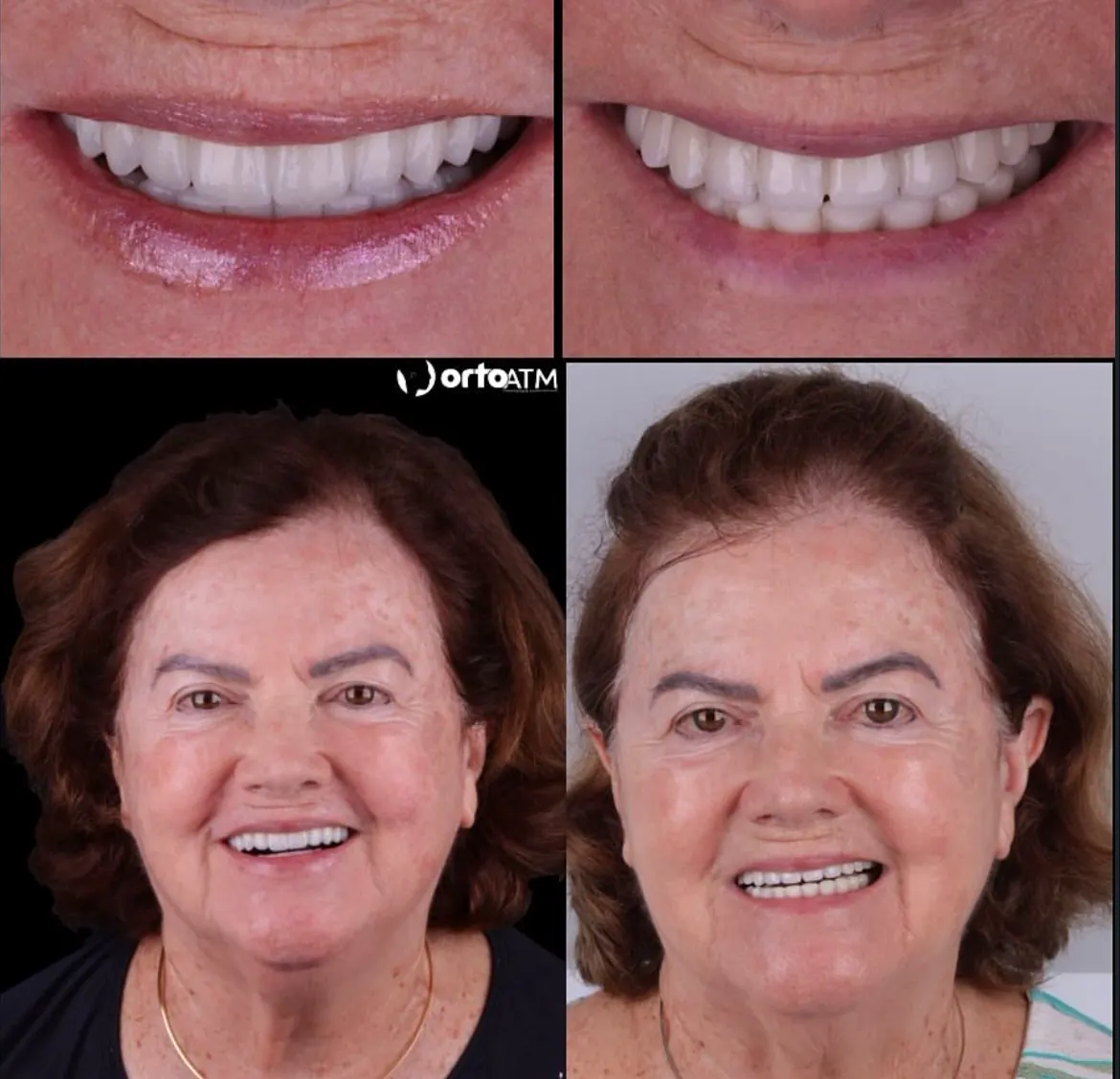 Antes e depois de prótese fixa na OrtoATM