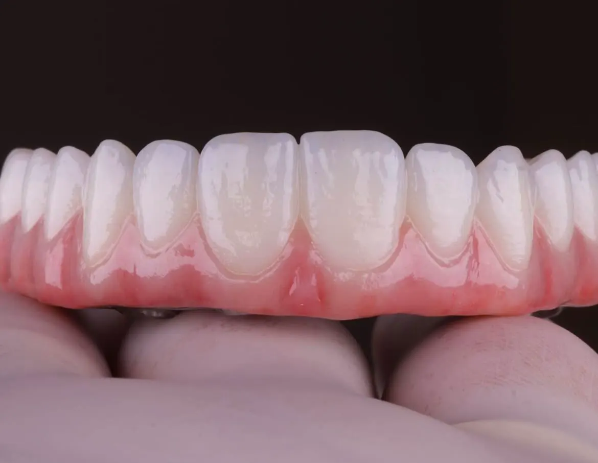 Ponte fixa de porcelana produzida no laboratório da OrtoATM